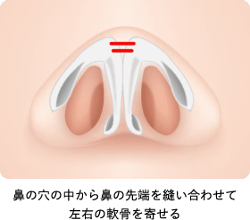 鼻の穴の中から鼻の先端を縫い合わせて左右の軟骨を寄せる