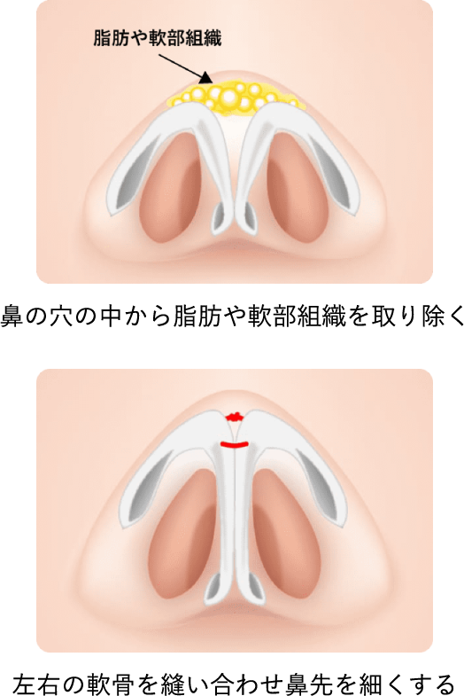 鼻の穴の中から脂肪や軟部組織を取り除く 左右の軟骨を縫い合わせ鼻先を細くする