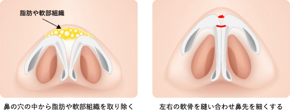 鼻の穴の中から脂肪や軟部組織を取り除く 左右の軟骨を縫い合わせ鼻先を細くする