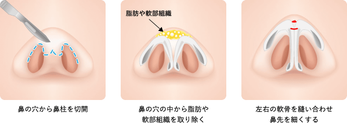 鼻の穴から鼻柱を切開 鼻の穴の中から脂肪や軟部組織を取り除く 左右の軟骨を縫い合わせ鼻先を細くする