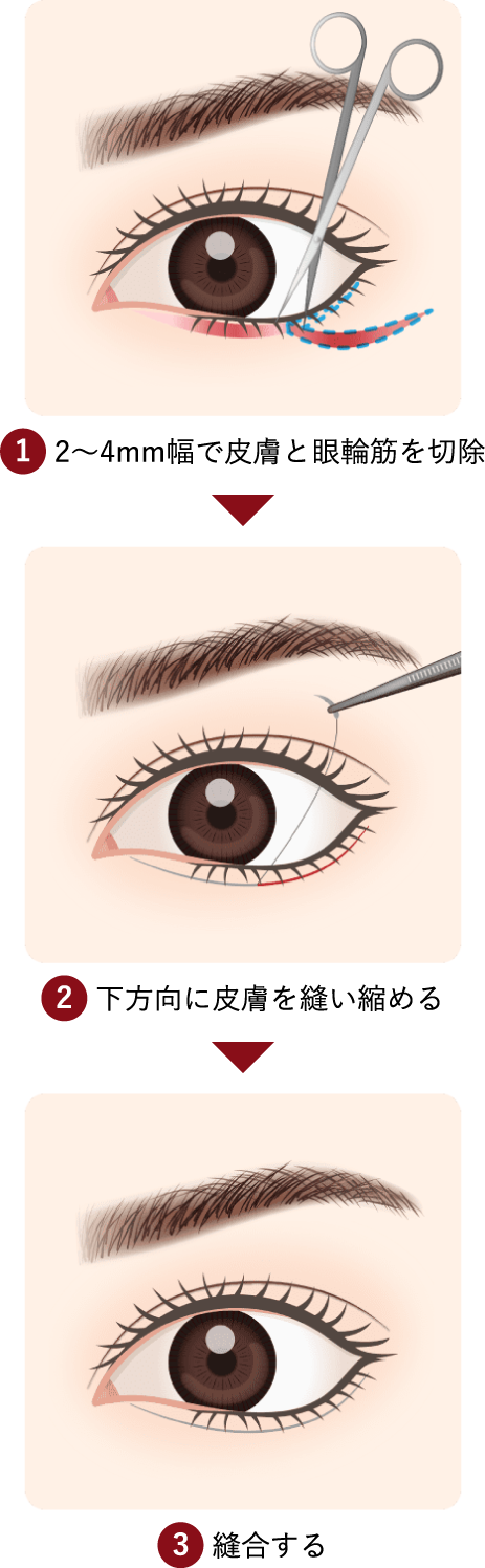 1 2～4mm幅で皮膚と眼輪筋を切除 2 下方向に皮膚を縫い縮める 3 縫合する 
