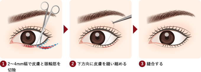1 2～4mm幅で皮膚と眼輪筋を切除 2 下方向に皮膚を縫い縮める 3 縫合する 