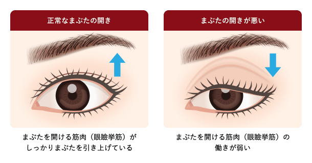 仕上がり重視 眼瞼下垂治療とは？