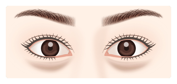目の下の凹凸改善 下眼瞼切開術（ハムラ法）とは？