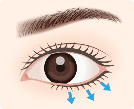 たれ目形成の下眼瞼開大術（アーモンドアイ）とは？