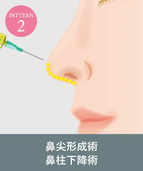鼻尖形成術　鼻柱下降術