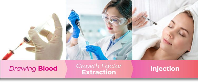 Drawing Blood > Growth Factor Extraction > Injections Into the Skin