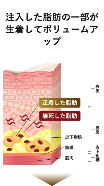 注入した脂肪の一部が生着してボリュームアップ