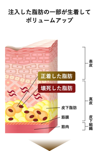 注入した脂肪の一部が生着してボリュームアップ