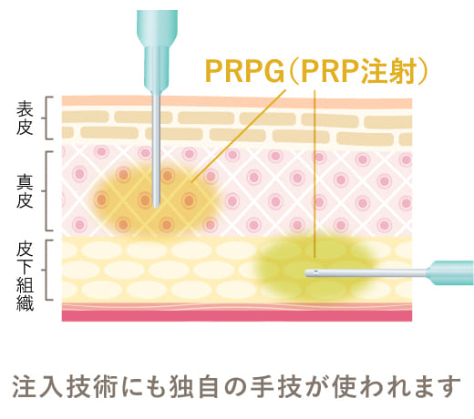 ６種類のPRPG