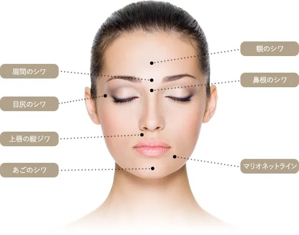 ボトックス注入の適応部位