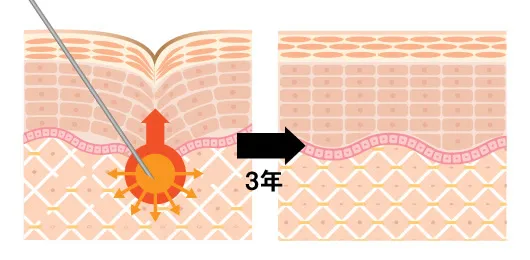 PRP注射 for MENは、薬剤の注入治療などのように、数ヶ月で効果が切れるのではありません。