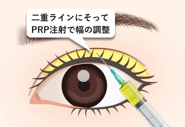 二重ラインにそってPRP注射で幅の調整