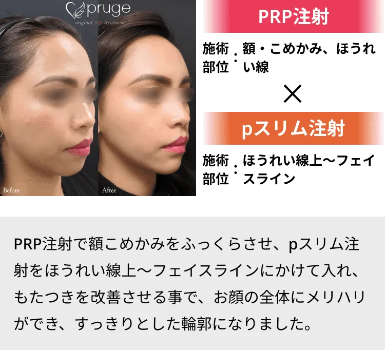 PRP注射で凹みをボリュームアップ＆脂肪のボリュームダウン注射のみで自然なリフトアップ効果