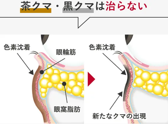 茶クマや黒クマは治らない