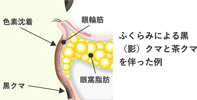 Step 1 目の下のふくらみに加えて、茶クマや黒クマ（影クマ）を伴ったクマ