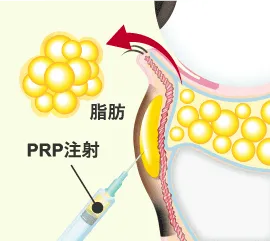 Step 2 下まぶたの裏側（結膜）から余分な脂肪を取り、同時にクマの原因部にPRP注射を行う