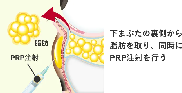 Step 2 下まぶたの裏側（結膜）から余分な脂肪を取り、同時にクマの原因部にPRP注射を行う