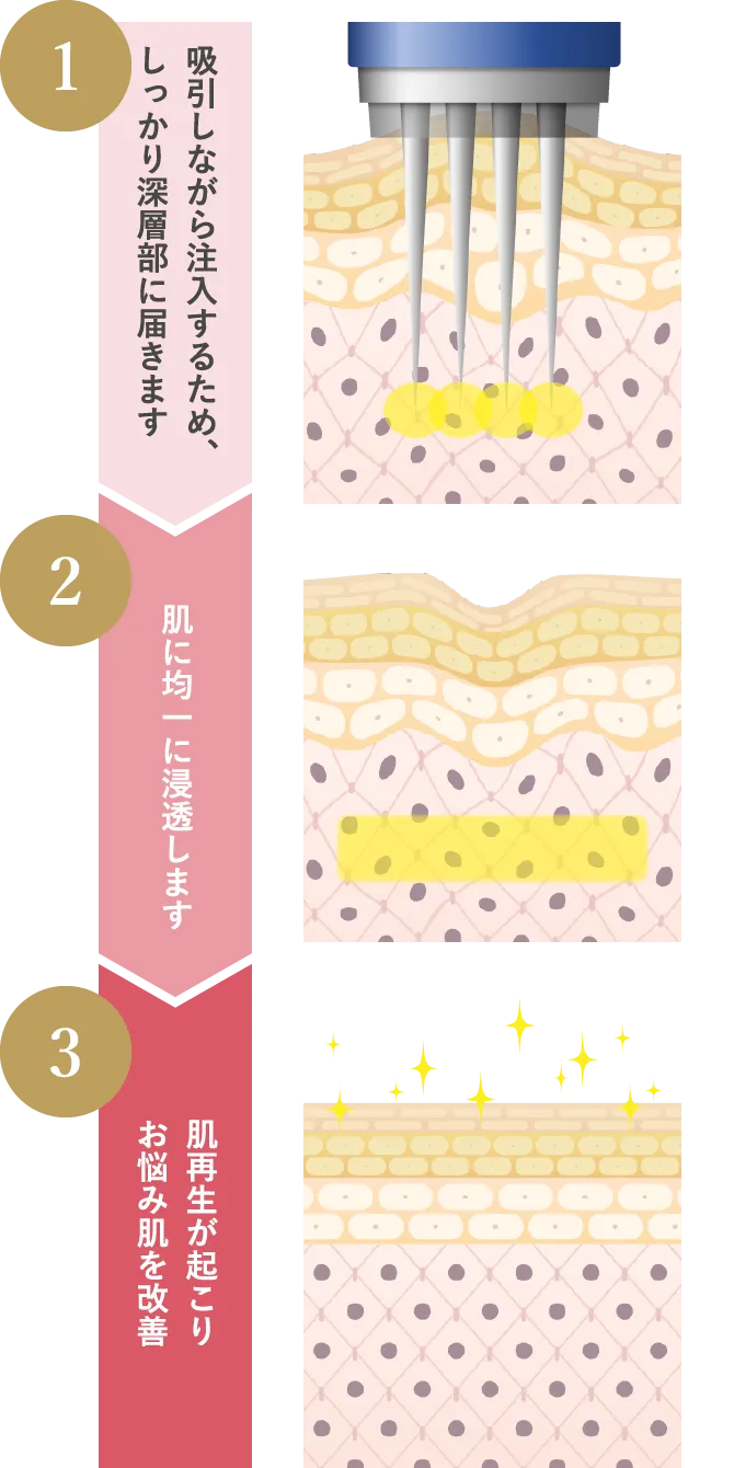 吸引しながら注入するため、しっかり深層部に届きます 肌に均一に浸透します 肌再生が起こりお悩み肌を改善