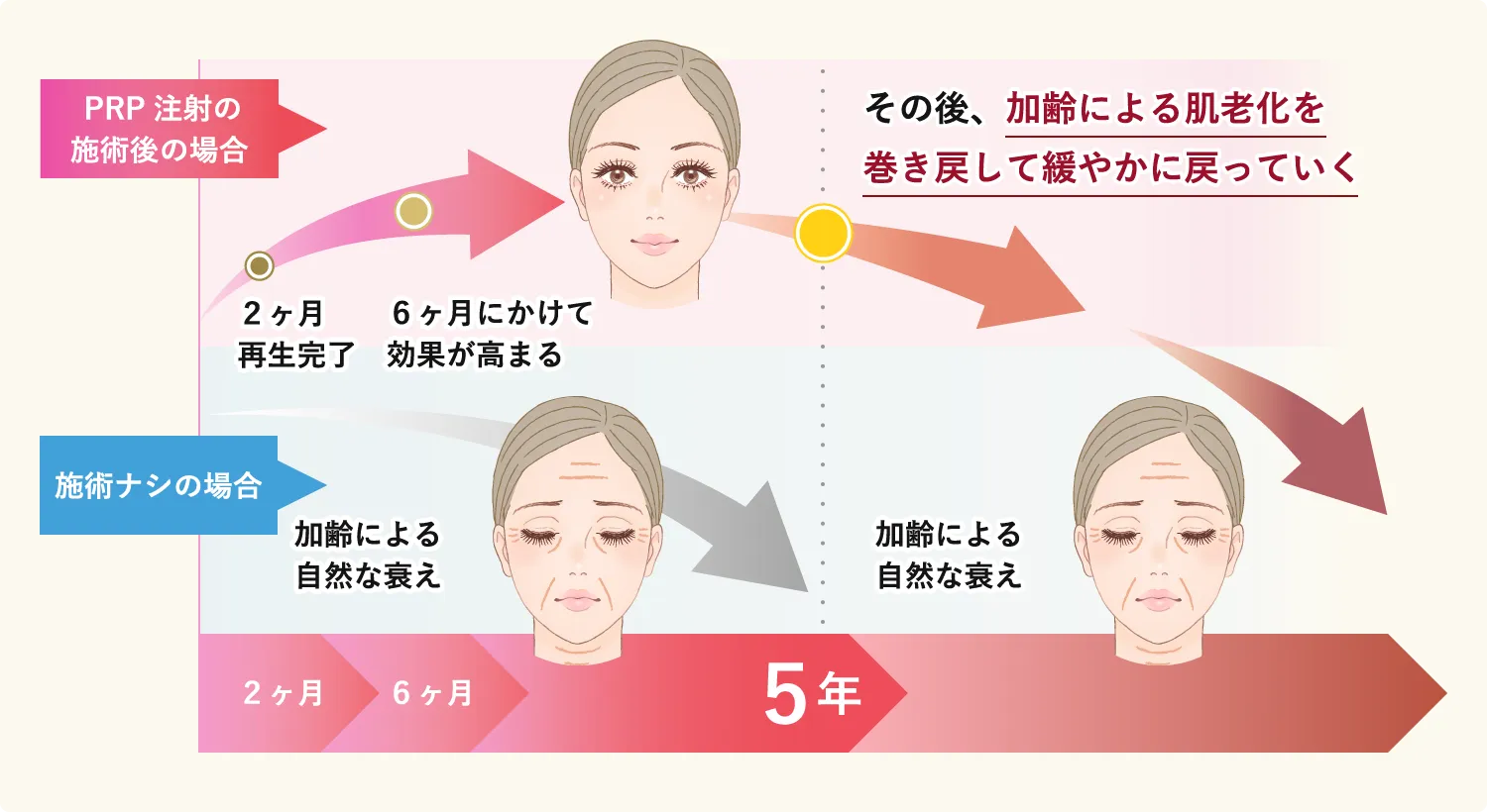 PRP注射の施術後の場合　2か月再生完了　6ヶ月にかけて効果が高まる　その後、加齢による肌老化を巻き戻して緩やかに戻っていく　施術ナシの場合　加齢による自然な衰え　加齢による自然な衰え　2か月　6ヶ月　5年