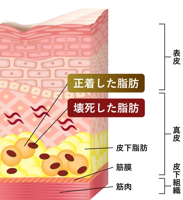 表皮　真皮　皮下組織　正着した脂肪　壊死した脂肪　皮下脂肪　筋膜　筋肉