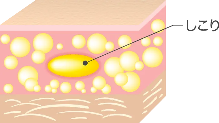 しこり