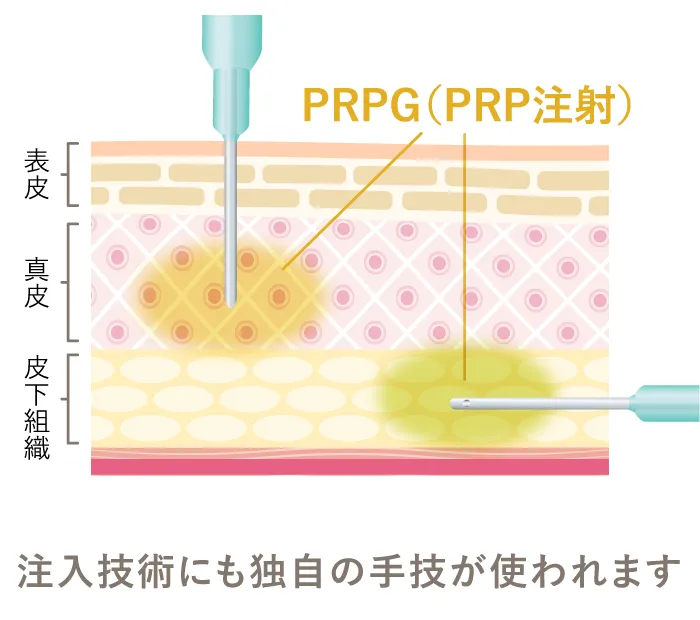 ＰＲＰＧ（ＰＲＰ注射）　表皮　真皮　皮下組織　注入技術にも独自の手技が使われます